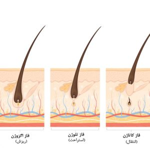 لیزر چگونه موهای زائد را از بین می‌برد؟