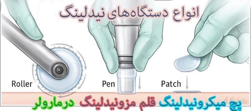 تفاوت مزونیدلینگ و میکرونیدلینگ