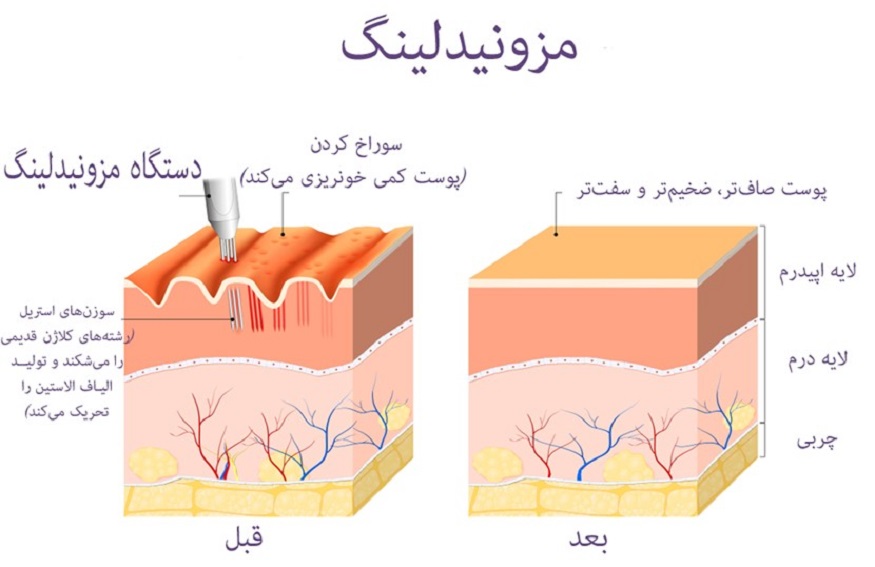 مزونیدلینگ پوست چیست؟